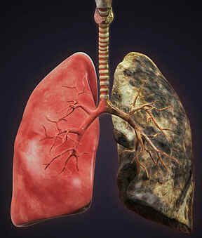 Enfisema