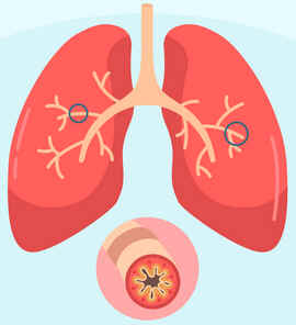 Enfisema