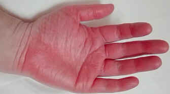 Eritromelalgia