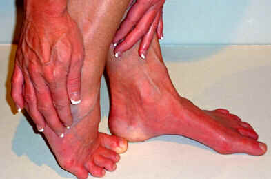 Eritromelalgia