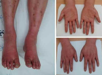 Eritromelalgia