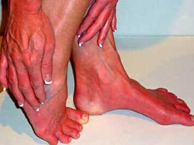 Eritromelalgia