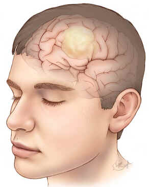 Glioma