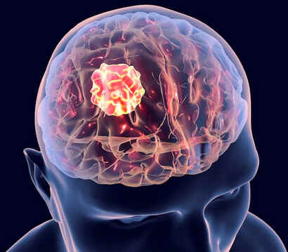Glioma
