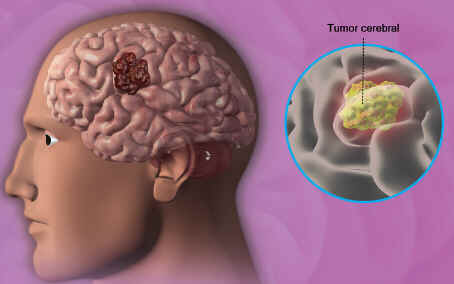 Glioma