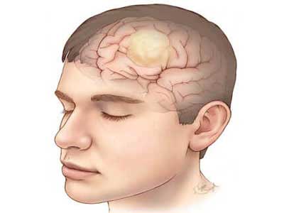 Glioma