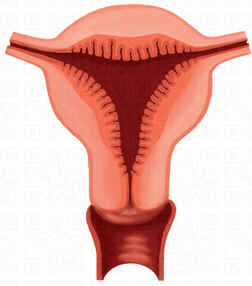 Hiperplasia Endometrial