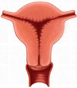 Hiperplasia Endometrial