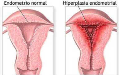Hiperplasia Endometrial