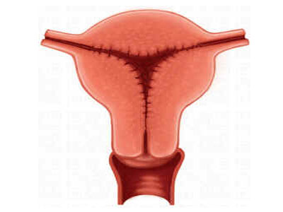 Hiperplasia Endometrial