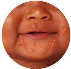 Impetigo