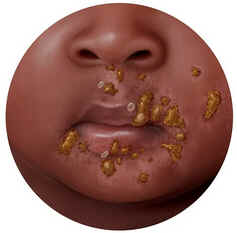 Impetigo