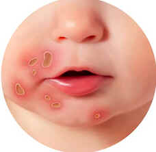 Impetigo