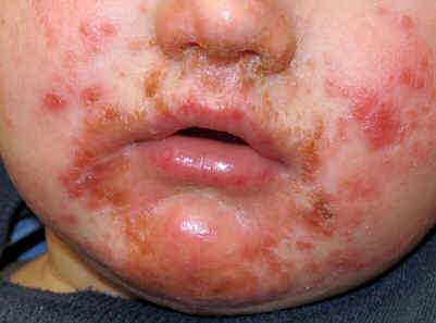 Impetigo