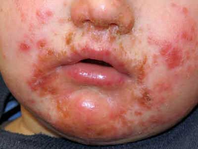 Impetigo