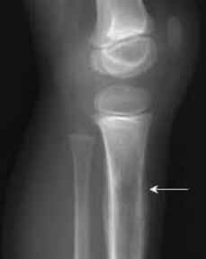 Sarcoma de Ewing