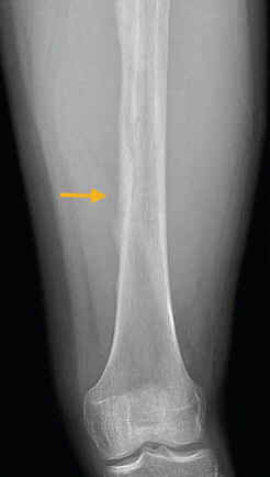 Sarcoma de Ewing