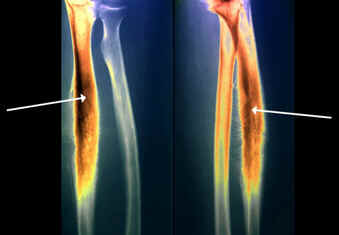 Sarcoma de Ewing