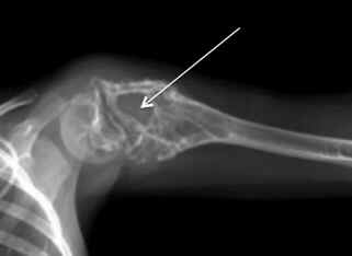 Sarcoma de Ewing