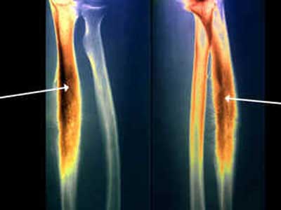 Sarcoma de Ewing