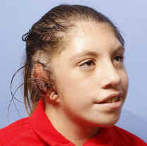 Síndrome de Goldenhar