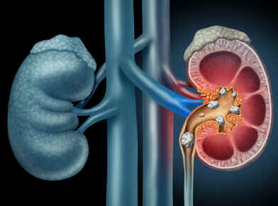 Cólica renal