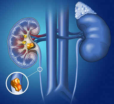 Cólica renal