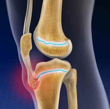 Doença de Osgood-Schlatter
