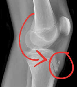 Doença de Osgood-Schlatter
