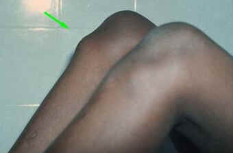 Doença de Osgood-Schlatter