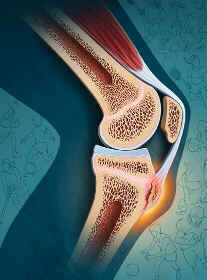 Doença de Osgood-Schlatter