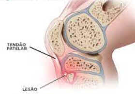 Doença de Osgood-Schlatter
