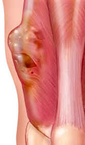 Sarcoma