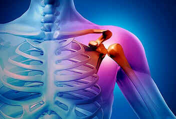 Sarcoma