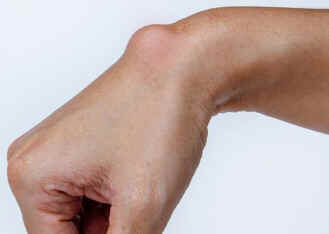 Sarcoma