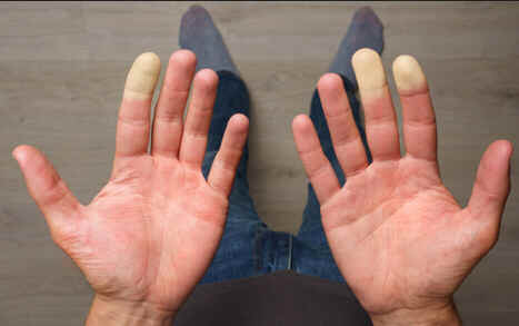 Síndrome de Raynaud