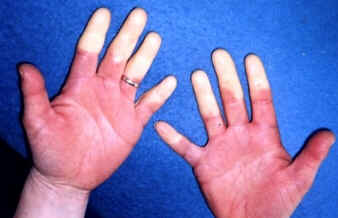 Síndrome de Raynaud