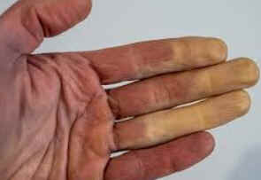 Síndrome de Raynaud